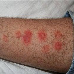 Bed bug bite reactions range from nothing to shock in Atlanta, GA.