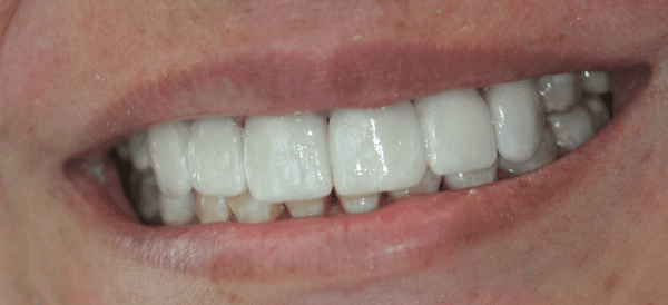 After 6 Veneers-Dentistry by Dr. Kaocharoen