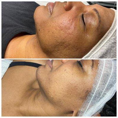 Microneedling treatment for aging skin