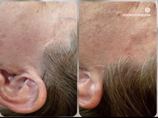 Face lift scar before & after