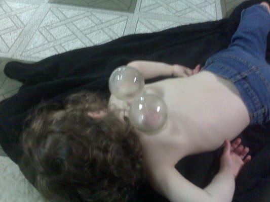 Cupping Therapy