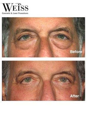 Patient underwent lower eyelid surgery with a lateral tarsal strip