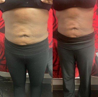 Lipo cavitation +Radio frequency treatment same day results one session before and after picture.