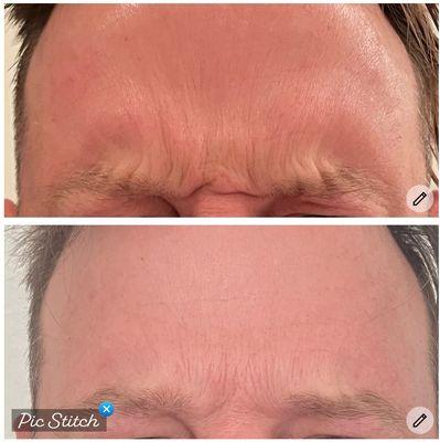 1st Botox session for this gentleman, we saw him back 3 weeks later for a touch up, great improvement!