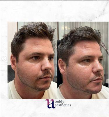 Before and After Radiesse Jaw and Chin filler