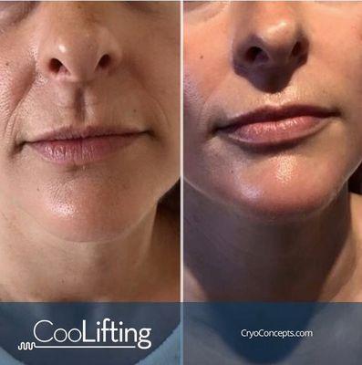 Before and after Coolifting treatment. A non-invasive, pain free, needle free, lifting, tightening, plumping, hydrating 5 minute treatment.