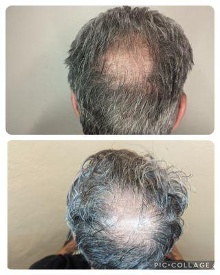 Hair restoration