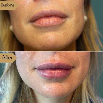 Filler Before/After