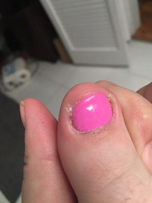 This is the toe the destroyed. It's ingrown on both sides now so badly it hurts to wear shoes