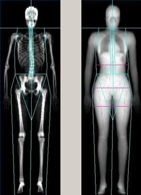 DEXA scanning to find out your fat/muscle ratio in each body part