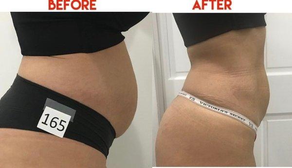 This is a before and after of just one month treatment with @gloriahincapie  and her team #bodyshapingandcontouring