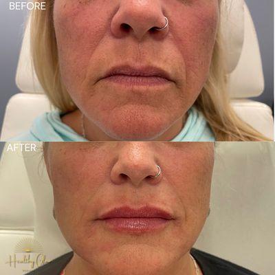 Perioral rejuvenation with filler.