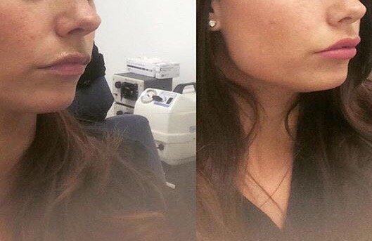 Before and after 1 day post lip filler. Used Restylane Silk.