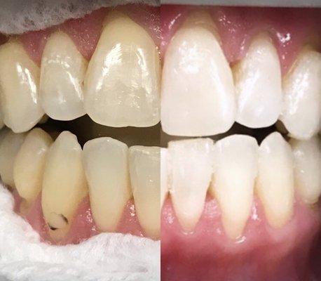 Zoom whitening!!!!!