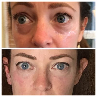 Tear troughs (under eye hollows) with dermal fillers