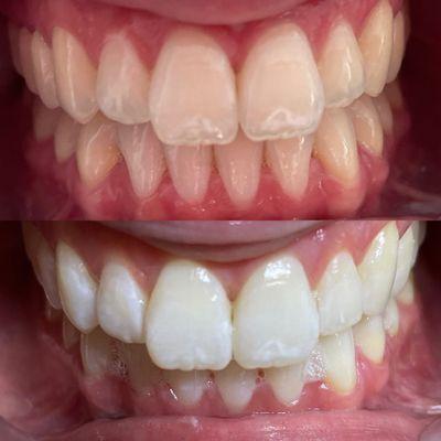 Before and After Teeth Whitening