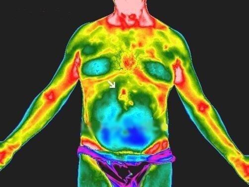 Early detection of ulcer with thermography instead of radiation