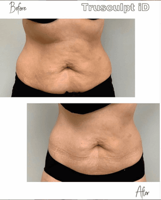 Trusculpt non-invasive fat loss treatment