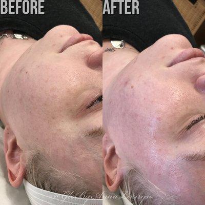 Dermaplaning facial. Before and After.