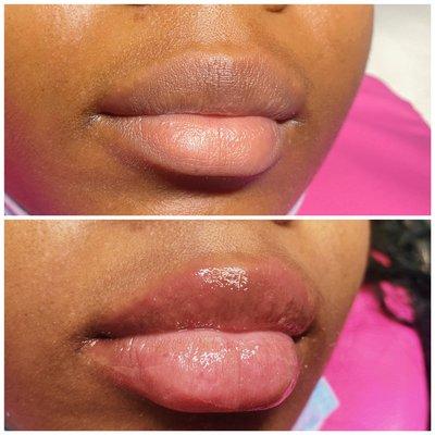 Hyaluronic Lip Filler