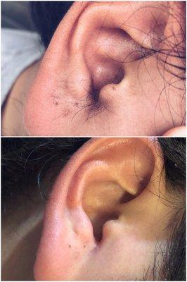 EAR WAXING