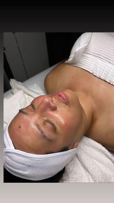 Dermaplane facial