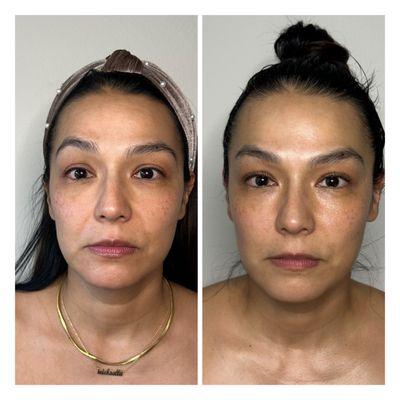 6-week series of Sculptural Face Lifting. My client received one treatment a week for six weeks, and these are her magical results.