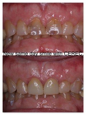 Crowns placed on two front teeth due to old fillings and cracking, same day smile with CEREC technology.