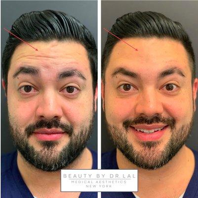 Our handsome patient before and 2 weeks after Botox treatment to reduce deep wrinkles and fine lines.