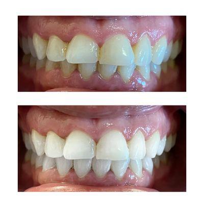 Teeth whitening-60 minute