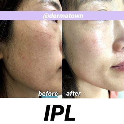 IPL photo facial