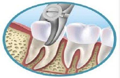 Simple And Surgical Extractions