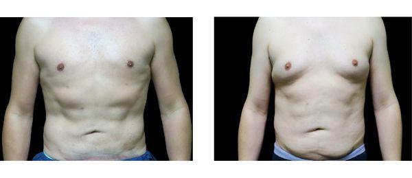 Gynecomastia surgery