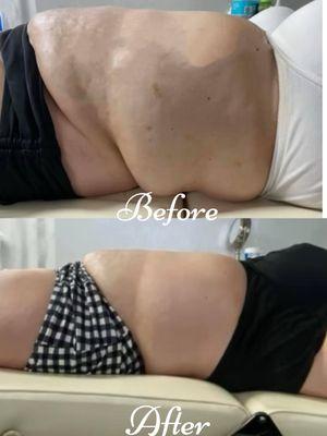 Before & After Láser Lipo Treatment