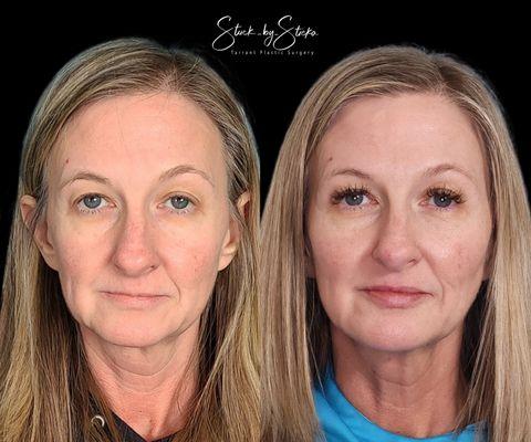 Full face rejuvenation with Botox and Juvederm Filler