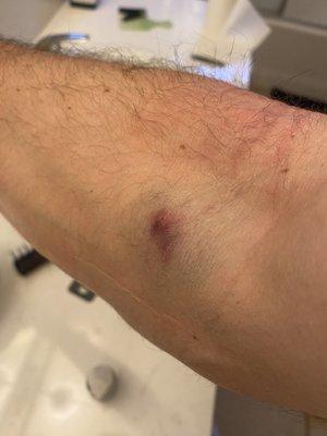 This was an hour after my blood was drawn. Very swollen and obvious bruising already. DR CRAIG JORGENSON NEVER SHOWS UP!