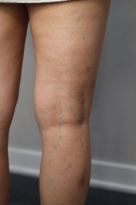 Varicose veins may be unsightly but the more important reason for treatment is to protect your heart.  Call us to explain