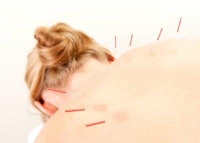 Acupuncture