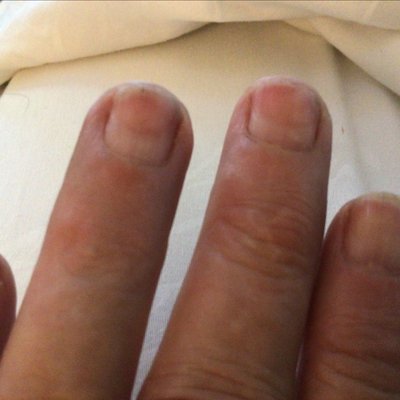 This is the damage they did by removing the gel, they took my nail down to the last layer. It has been a month