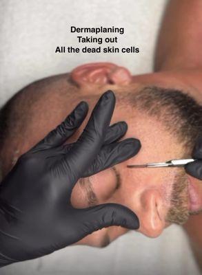 Dermaplaning is for everyone to get rid of the skin dead skin cells and have a smoother & healthier looking!