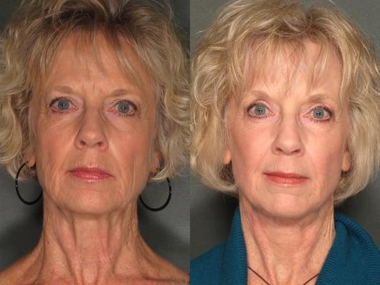 67 year old female post facelift, deep Erbium laser and upper Blepharoplasty.