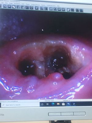 Here is a picture of my mouth after they mangled my gums and left broken pieces of Teeth in my mouth with exposed bone     Thanks