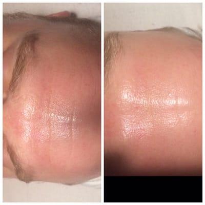 Smooth your forehead naturally with Microcurrent. This was one session on a 34 yo male.