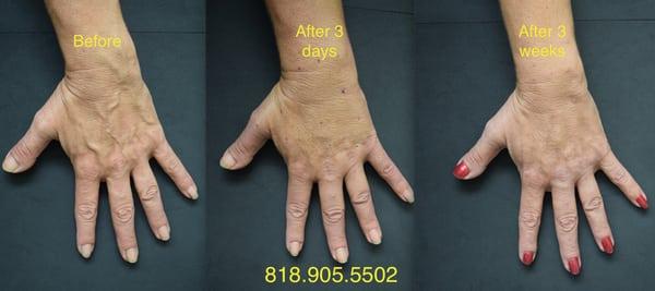 Hand veins as treated in our office and the results. The patient is visible if one comes for a consultation as she is my office manager ...