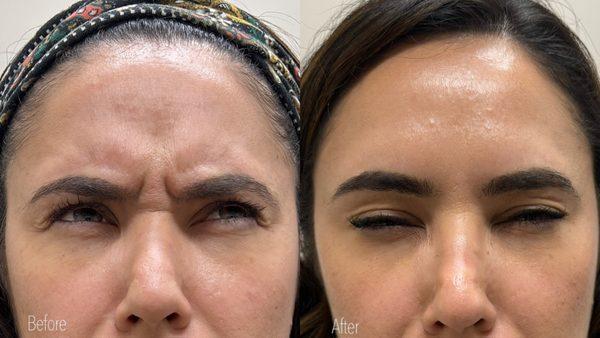 Wrinkle relaxing between eyebrows