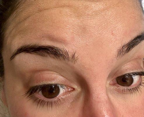 Indent with bruising and bump adjacent to this over right eyebrow (left in picture)