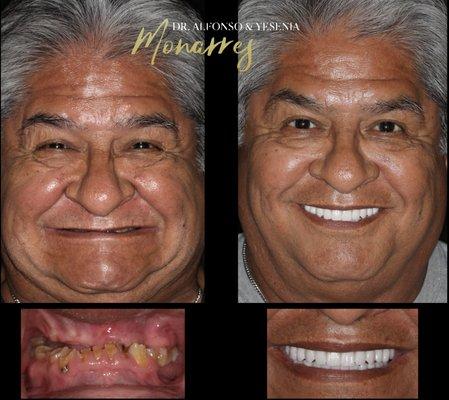 Full mouth immediate reconstruction with dental implants for the severe wear patient by Dr. Alfonso Monarres.