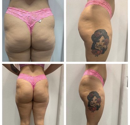 Cellulite treatment