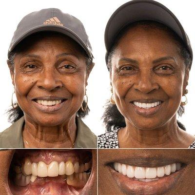 Beautiful before/after with Full Mouth Implants