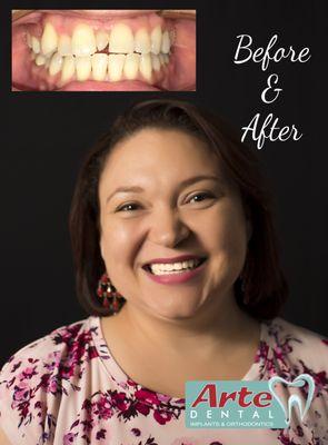 An EXCELLENT Invisalign outcome!